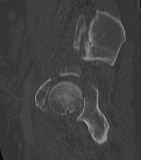 Acetabular Fracture 2 Column